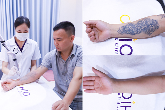 Điểm khác biệt của Chương trình xóa xăm mùa 5 tại Thẩm mỹ OHIO - Phòng khám da liễu OHIO chương trình xoá xăm