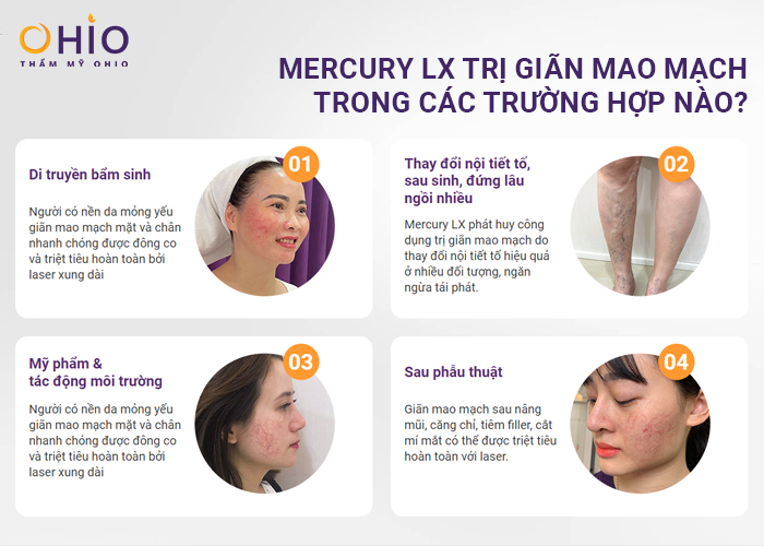 Trị giãn mao mạch Mercury LX: Liệu trình ngắn, hiệu quả nhanh chóng - Phòng khám da liễu OHIO Trị giãn mao mạch Mercury LX: Liệu trình ngắn, hiệu quả nhanh chóng