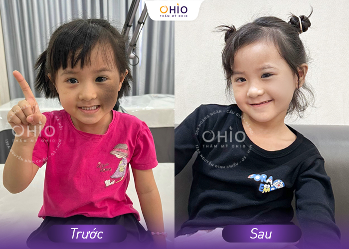 Xóa sạch chàm bớt với tổ hợp công nghệ PICO: Không ảnh hưởng nền da, an toàn, hiệu quả - Phòng khám da liễu OHIO Xóa sạch chàm bớt với tổ hợp công nghệ PICO: Không ảnh hưởng nền da, an toàn, hiệu quả