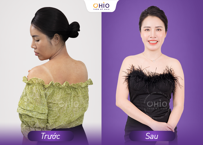 Tắm trắng Natural White: Bật tone, da trắng khỏe, mịn màng - Phòng khám da liễu OHIO Tắm trắng Natural White: Bật tone, da trắng khỏe, mịn màng