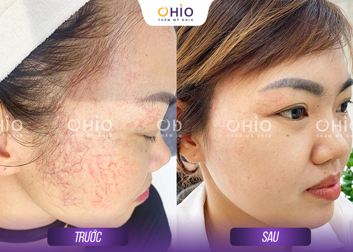 Trị giãn mao mạch Mercury LX: Liệu trình ngắn, hiệu quả nhanh chóng - Phòng khám da liễu OHIO Trị giãn mao mạch Mercury LX: Liệu trình ngắn, hiệu quả nhanh chóng