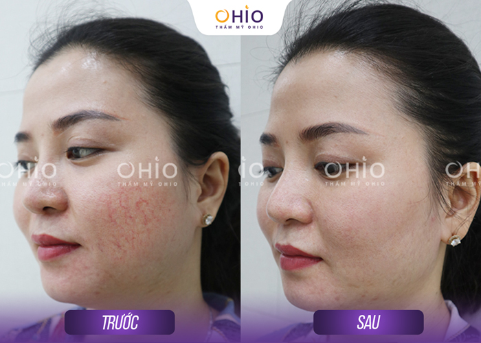 Trị giãn mao mạch Mercury LX: Liệu trình ngắn, hiệu quả nhanh chóng - Phòng khám da liễu OHIO Trị giãn mao mạch Mercury LX: Liệu trình ngắn, hiệu quả nhanh chóng