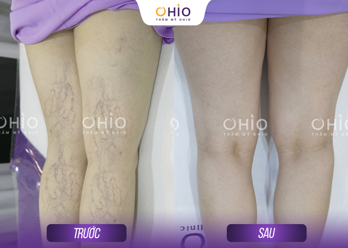 Trị giãn mao mạch Mercury LX: Liệu trình ngắn, hiệu quả nhanh chóng - Phòng khám da liễu OHIO Trị giãn mao mạch Mercury LX: Liệu trình ngắn, hiệu quả nhanh chóng