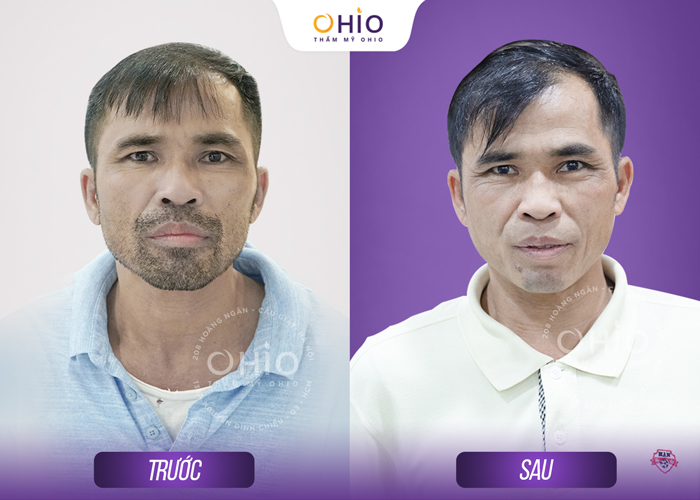 Tổ hợp công nghệ triệt lông cho nam Aqua Max Pro & Diode Men an toàn, sạch - Phòng khám da liễu OHIO Tổ hợp công nghệ triệt lông cho nam Aqua Max Pro & Diode Men an toàn, sạch