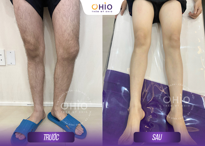 Tổ hợp công nghệ triệt lông cho nam Aqua Max Pro & Diode Men an toàn, sạch - Phòng khám da liễu OHIO Tổ hợp công nghệ triệt lông cho nam Aqua Max Pro & Diode Men an toàn, sạch