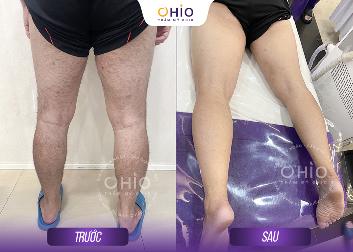 Tổ hợp công nghệ triệt lông cho nam Aqua Max Pro & Diode Men an toàn, sạch - Phòng khám da liễu OHIO Tổ hợp công nghệ triệt lông cho nam Aqua Max Pro & Diode Men an toàn, sạch