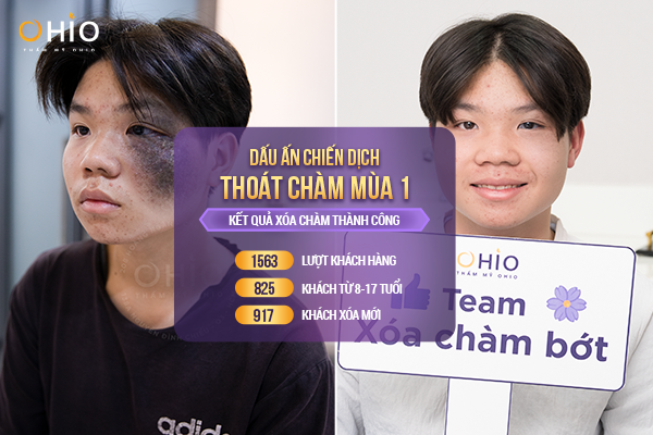 Chiến dịch Thoát Chàm 2023: Thẩm mỹ OHIO tài trợ 3 Tỷ xóa chàm