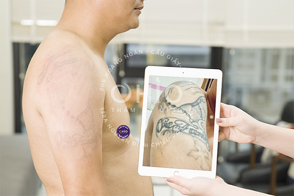 Khởi động chiến dịch xóa hình xăm 2023 - Cam kết sạch mực 100%