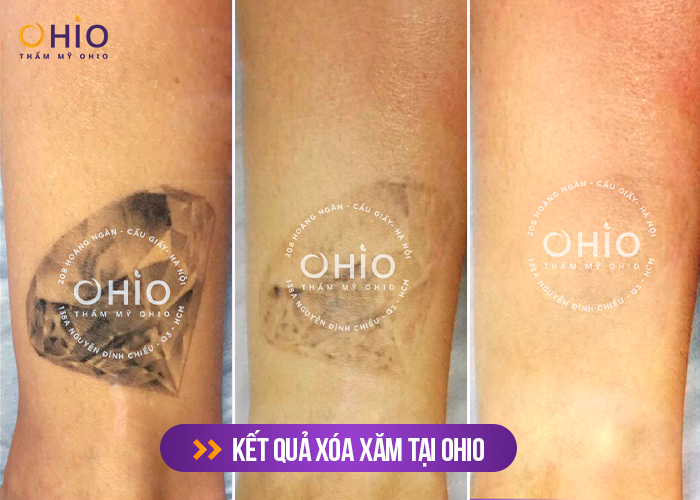 Khởi động chiến dịch xóa hình xăm 2023 - Cam kết sạch mực 100%