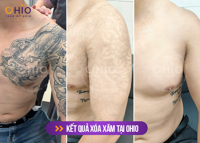 Khởi động chiến dịch xóa hình xăm 2023 - Cam kết sạch mực 100%