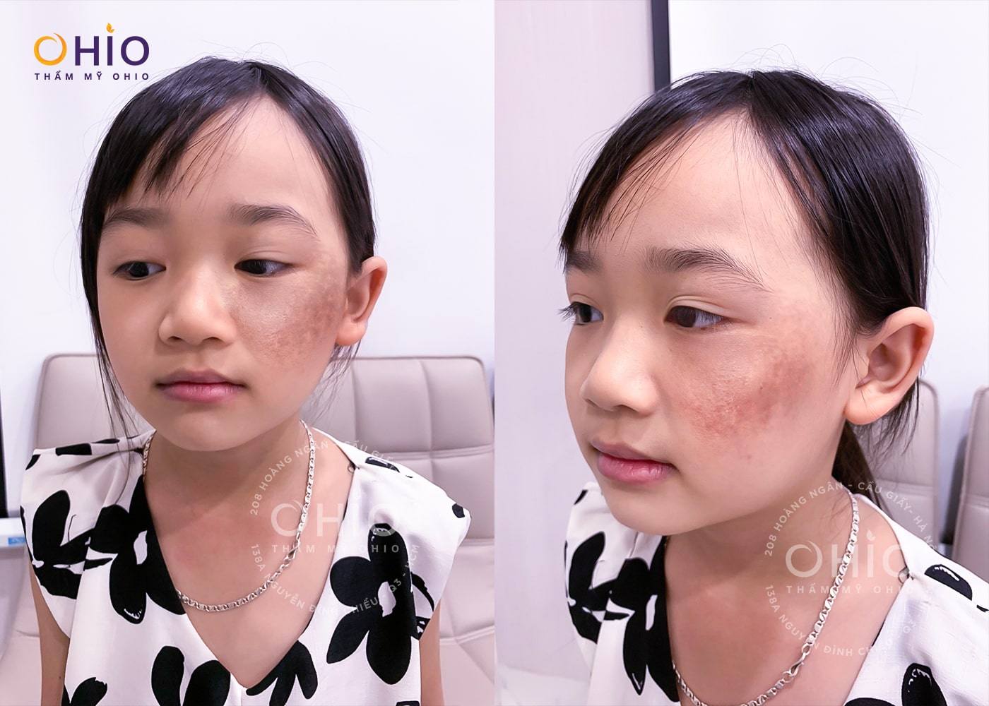 Tương lai tươi sáng sau khi xóa chàm của bé Ngọc Ánh tại OHIO - Phòng khám da liễu OHIO Vết bớt nâu trên má