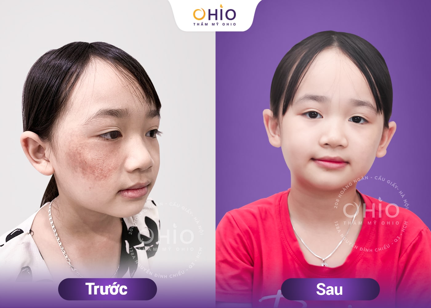 Tương lai tươi sáng sau khi xóa chàm của bé Ngọc Ánh tại OHIO - Phòng khám da liễu OHIO Tương lai tươi sáng sau khi xóa chàm của bé Ngọc Ánh tại OHIO