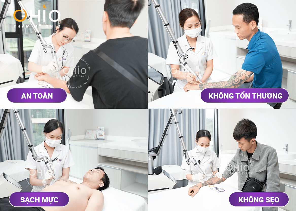 Cơ sở xóa xăm an toàn và uy tín tại Hà Nội: Những điều cần biết trước khi đưa ra quyết định - Phòng khám da liễu OHIO Cơ sở xóa xăm an toàn và uy tín tại Hà Nội: Những điều cần biết trước khi đưa ra quyết định