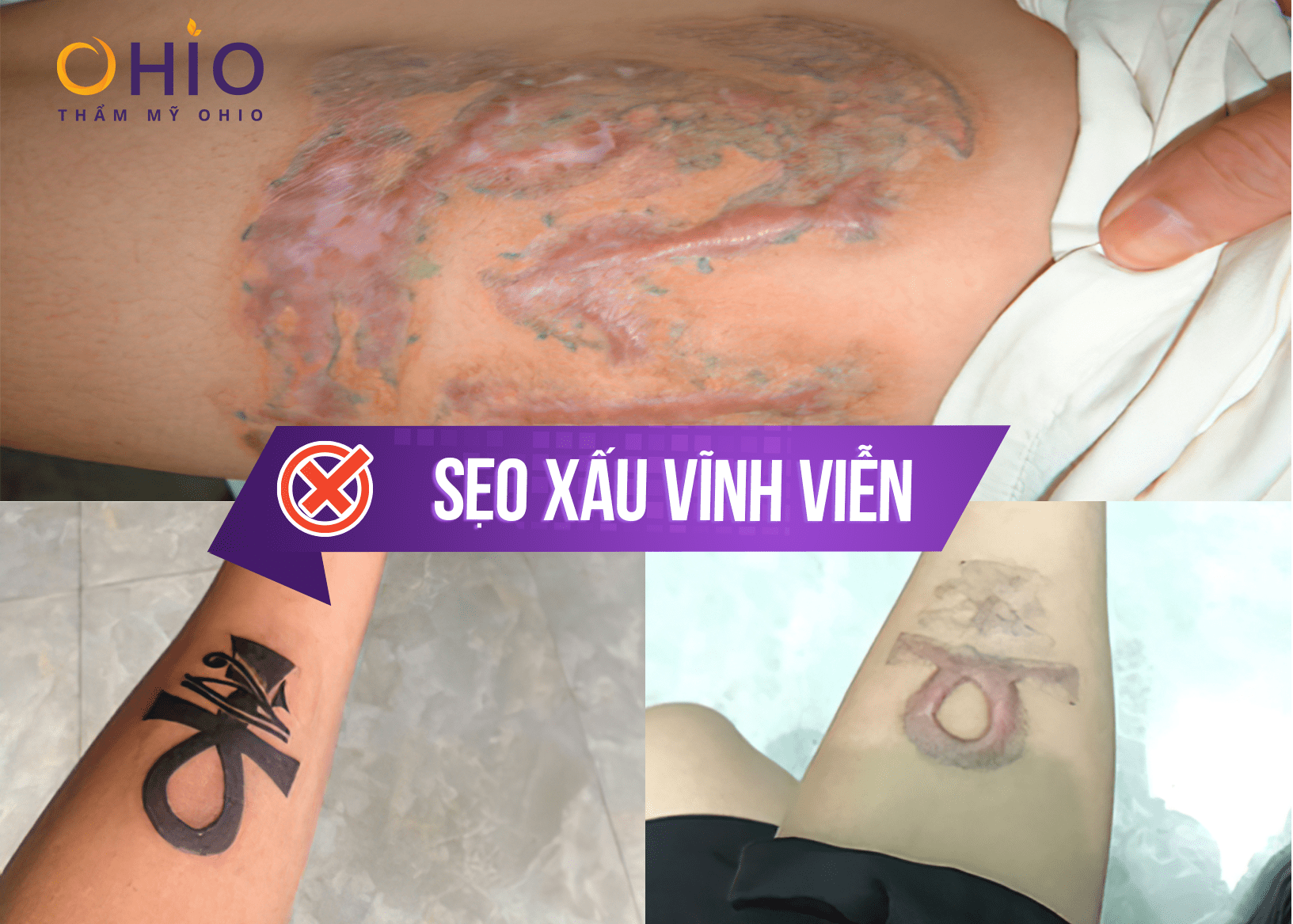 Chị Khánh Ly: OHIO đã vực dậy niềm tin xóa xăm cho tôi! - Phòng khám da liễu OHIO xóa hình xăm tại thẩm mỹ OHIO