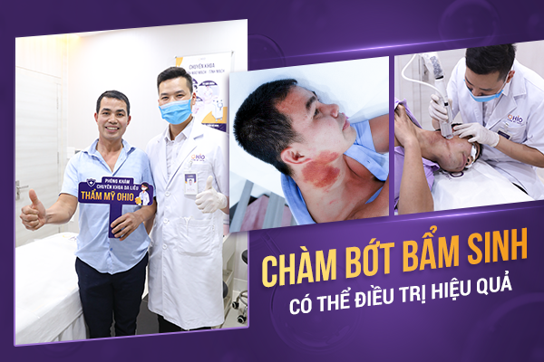 xóa sạch chàm bớt