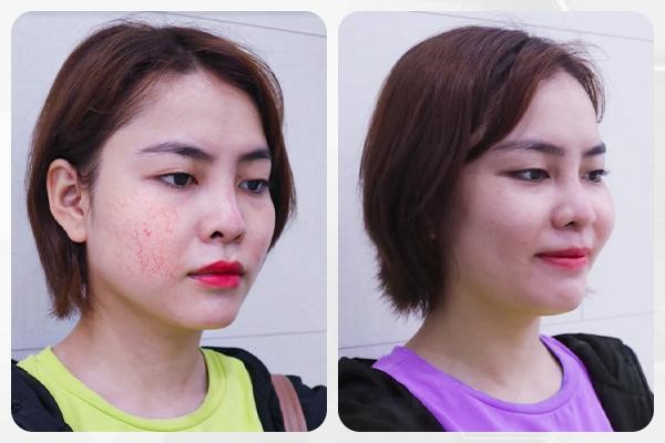 Chuyên khoa trị giãn mao mạch Thẩm mỹ OHIO khẳng định vị thế tại Việt Nam - Phòng khám da liễu OHIO Chuyên khoa trị giãn mao mạch Thẩm mỹ OHIO khẳng định vị thế tại Việt Nam