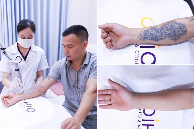 Điểm khác biệt của chiến dịch xóa xăm mùa 4 tại Thẩm mỹ OHIO - Phòng khám da liễu OHIO chương trình xoá xăm