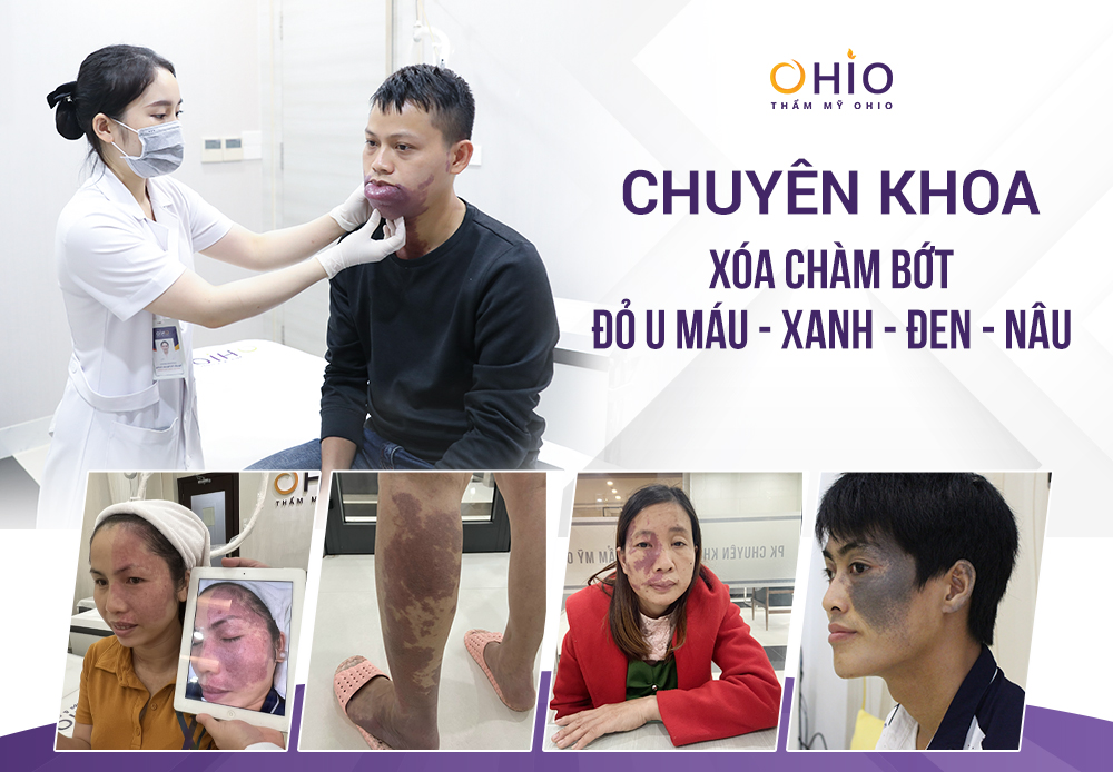 Hỗ trợ điều trị vết chàm bớt bẩm sinh uy tín tại Hà Nội - Phòng khám da liễu OHIO Hỗ trợ điều trị vết chàm bớt bẩm sinh uy tín tại Hà Nội