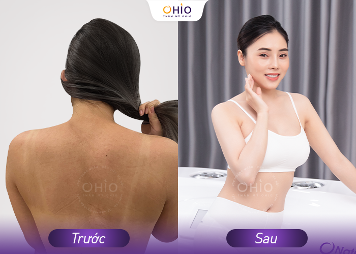 Phái đẹp rộn ràng trải nghiệm công nghệ tắm trắng chuẩn Đức - Phòng khám da liễu OHIO công nghệ tắm trắng chuẩn Đức 2