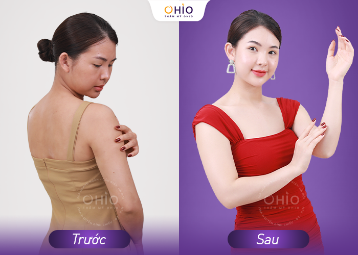 Phái đẹp rộn ràng trải nghiệm công nghệ tắm trắng chuẩn Đức - Phòng khám da liễu OHIO Phái đẹp rộn ràng trải nghiệm công nghệ tắm trắng chuẩn Đức
