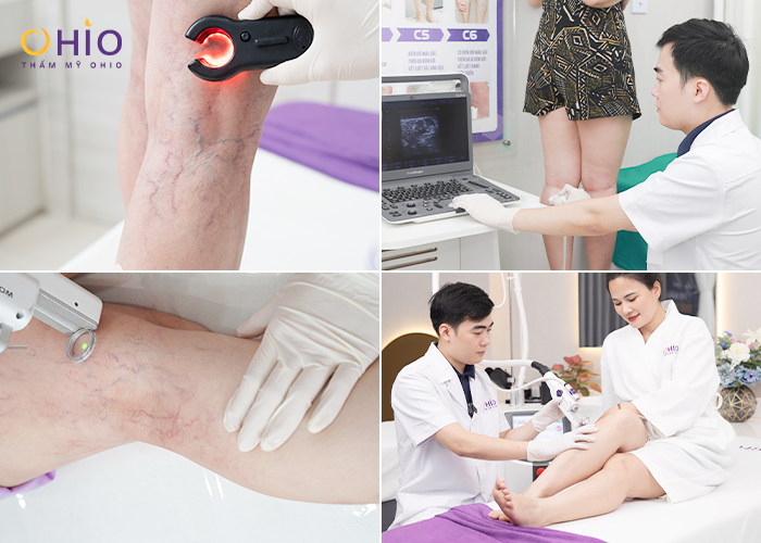 Review trị giãn mao mạch thực tế tại Thẩm mỹ OHIO - Phòng khám da liễu OHIO Review trị giãn mao mạch thực tế tại Thẩm mỹ OHIO