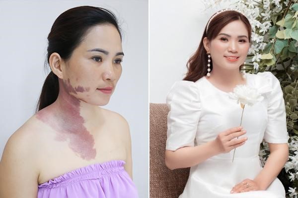 Thẩm mỹ OHIO - Đơn vị Xóa chàm lớn Việt Nam - Phòng khám da liễu OHIO Thẩm mỹ OHIO - Đơn vị Xóa chàm lớn Việt Nam