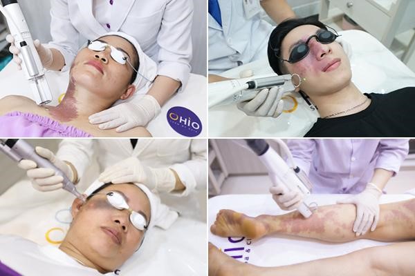Thẩm mỹ OHIO - Đơn vị Xóa chàm lớn Việt Nam - Phòng khám da liễu OHIO Thẩm mỹ OHIO - Đơn vị Xóa chàm lớn Việt Nam