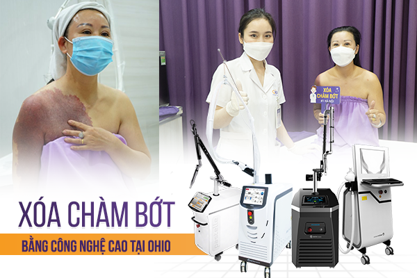 Thẩm mỹ OHIO khẳng định vị thế tại Việt Nam trong điều trị chàm bớt bẩm sinh