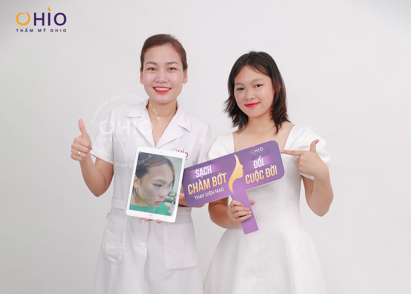 Ngọc Ánh 16 tuổi: Sạch chàm bớt đen nửa mặt sau 1 liệu trình tại OHIO