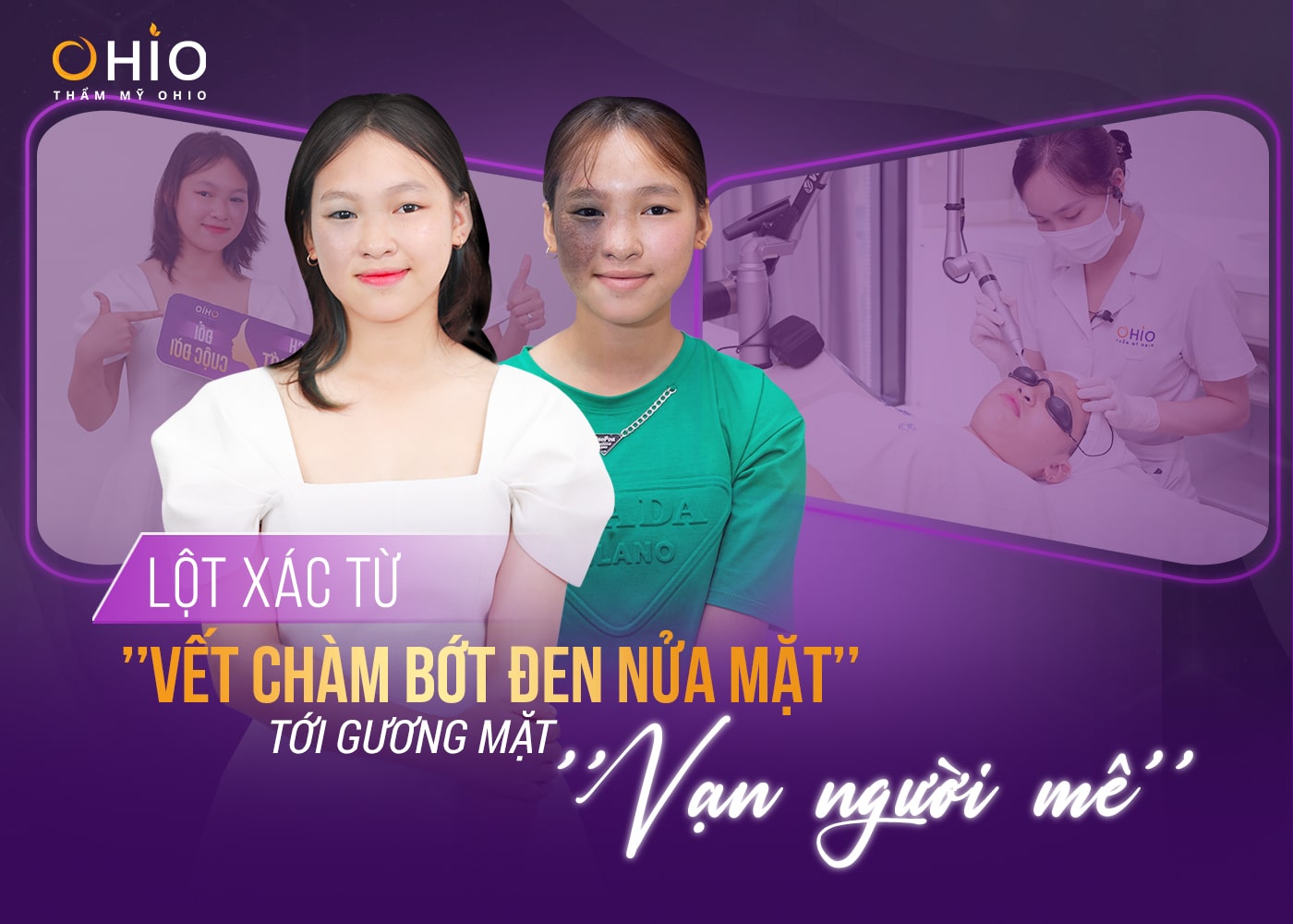 vết chàm bớt đen lan rộng
