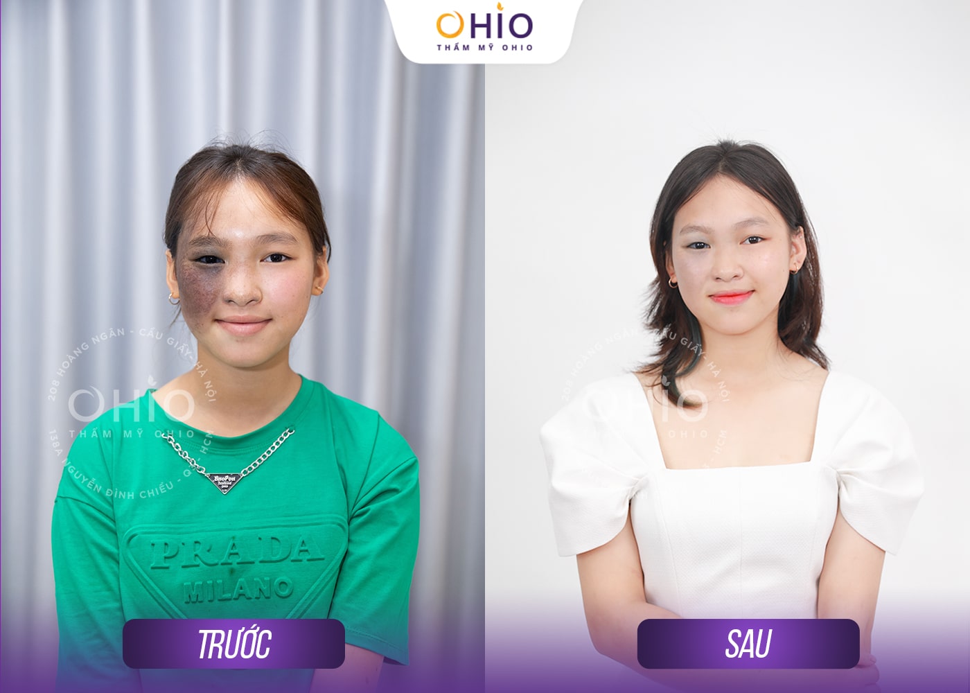 Ngọc Ánh 16 tuổi: Sạch chàm bớt đen nửa mặt sau 1 liệu trình tại OHIO