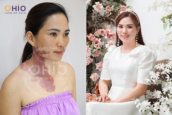 Chiến dịch Thoát Chàm 2023 thay diện mạo - đổi cuộc đời cho hàng ngàn khách hàng - Phòng khám da liễu OHIO Chiến dịch Thoát Chàm 2023 thay diện mạo - đổi cuộc đời cho hàng ngàn khách hàng