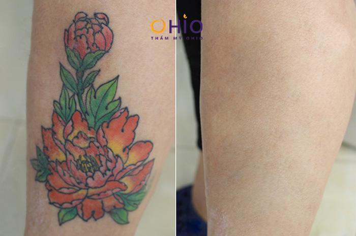 Địa chỉ xóa xăm uy tín ở Hà Nội được cấp phép bởi Sở y tế - Phòng khám da liễu OHIO Địa chỉ xóa xăm uy tín ở Hà Nội được cấp phép bởi Sở y tế