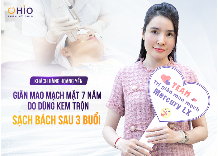 Giãn mao mạch do dùng kem trộn 7 năm trị sạch sau 1 liệu trình cực ngắn - Phòng khám da liễu OHIO Giãn mao mạch do dùng kem trộn