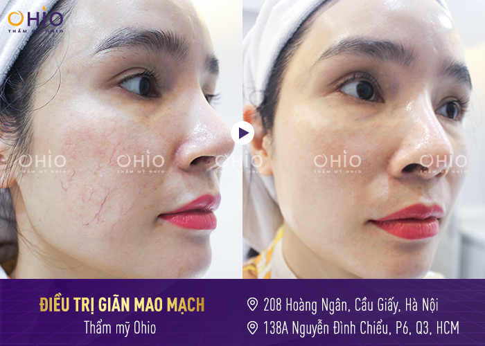 Giãn mao mạch do dùng kem trộn 7 năm trị sạch sau 1 liệu trình cực ngắn - Phòng khám da liễu OHIO trị giãn mao mạch tại Ohio