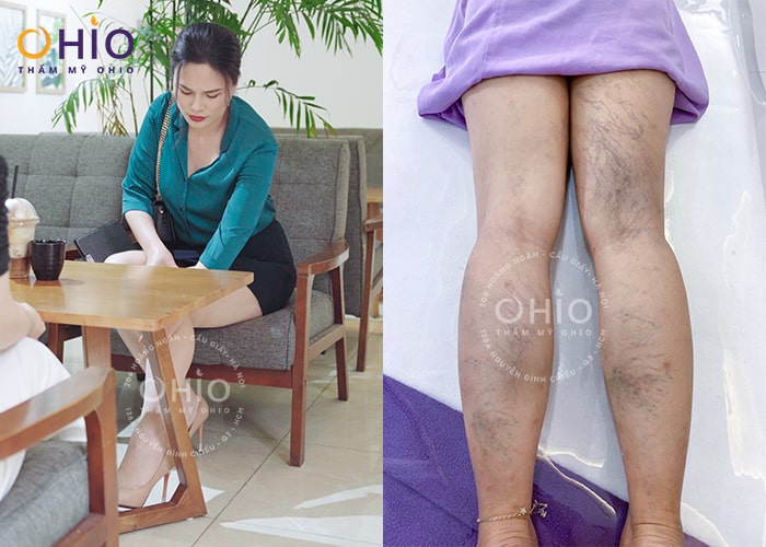 Bật mí cách sạch giãn mao mạch chân lâu năm của bà chủ nhà hàng 5 sao - Phòng khám da liễu OHIO trị sạch giãn mao mạch chân