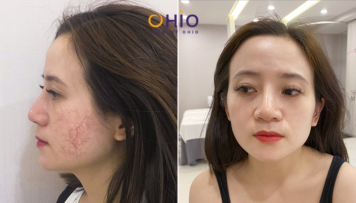 Trị giãn mao mạch có chấm dứt không? - Phòng khám da liễu OHIO trị giãn mao mạch kết thúc