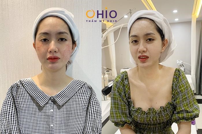 Trị giãn mao mạch có chấm dứt không? - Phòng khám da liễu OHIO trị giãn mao mạch kết thúc 3
