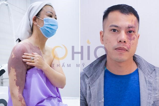 Xóa chàm bớt đỏ u máu bẩm sinh có khó không & trị ở đâu để đạt hiệu quả?