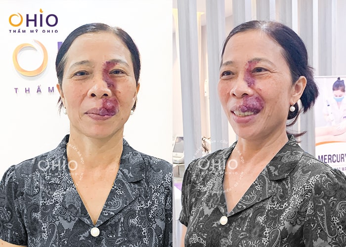 xoá chàm bớt đỏ rượu vang
