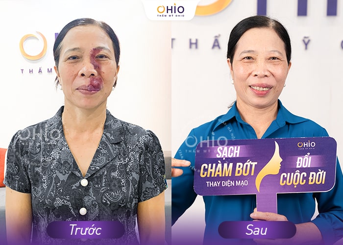 Cô Cao Thị Liễu: Hành trình xóa sạch chàm bớt đỏ ở tuổi 55 tại OHIO