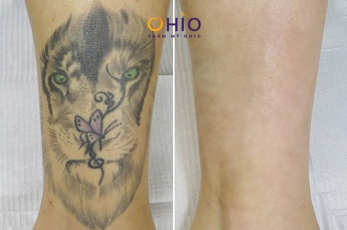 Thực hư việc xóa xăm bằng Laser tại cơ sở thẩm mỹ - Phòng khám da liễu OHIO xóa xăm bằng laser 1