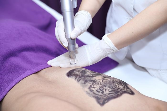 Thực hư việc xóa xăm bằng Laser tại cơ sở thẩm mỹ - Phòng khám da liễu OHIO xóa xăm bằng laser 4