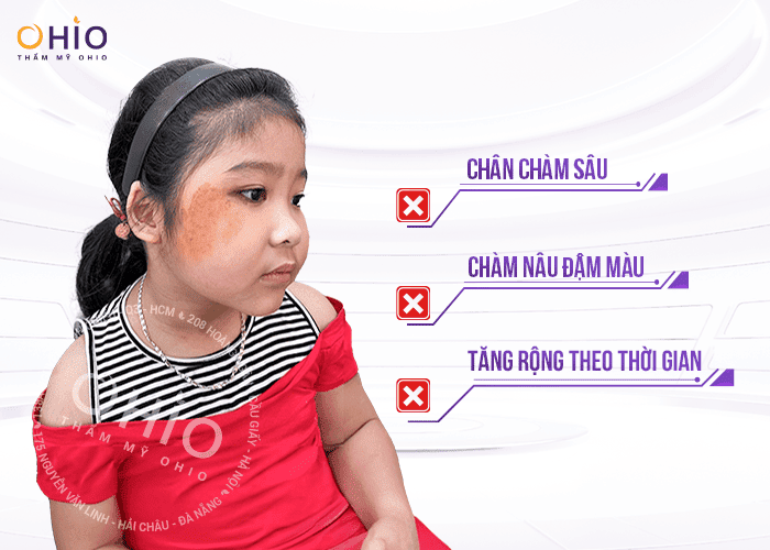 xoá chàm cho con