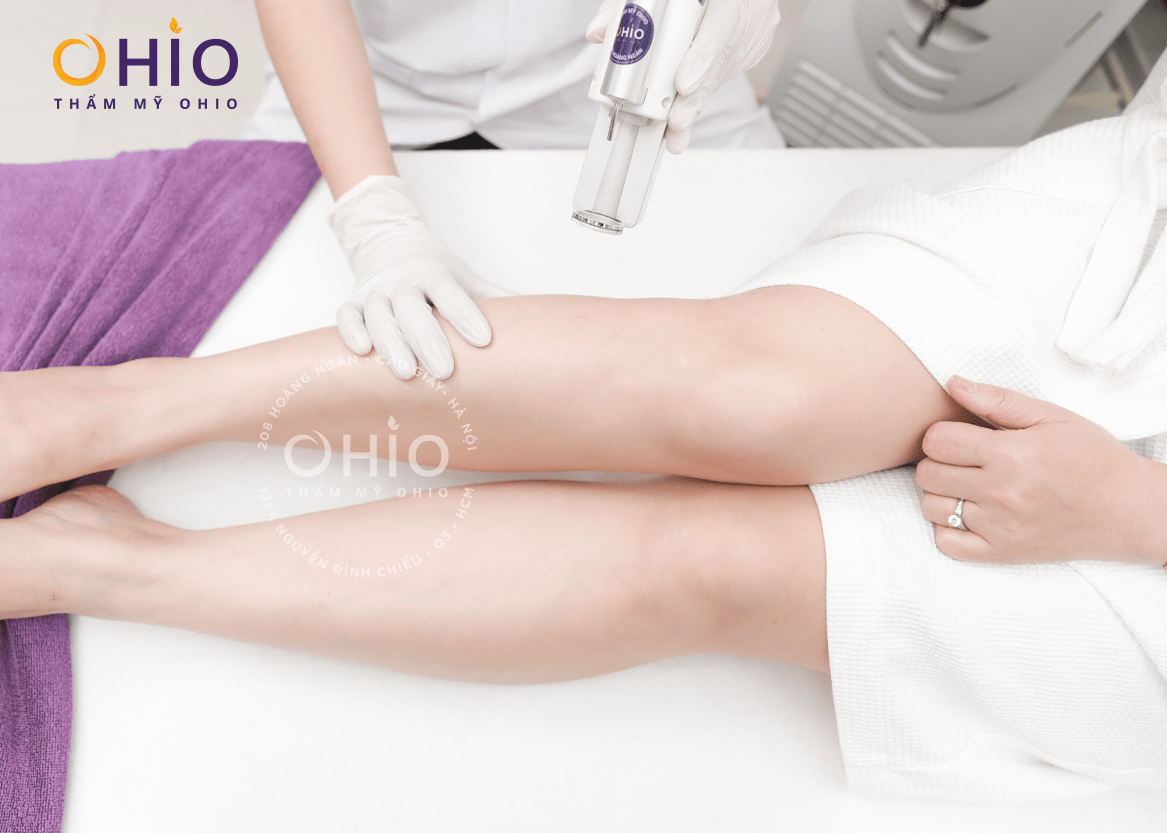 Chị Ngọc Thúy: Đôi chân khỏe đẹp - khi hết giãn mao mạch - Phòng khám da liễu OHIO gmm c thúy