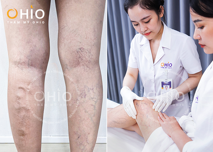 Bí quyết lấy lại đôi chân mất thẩm mỹ vì Giãn mao mạch của cô MC xinh đẹp - Phòng khám da liễu OHIO giãn mao mạch vùng chân đùi