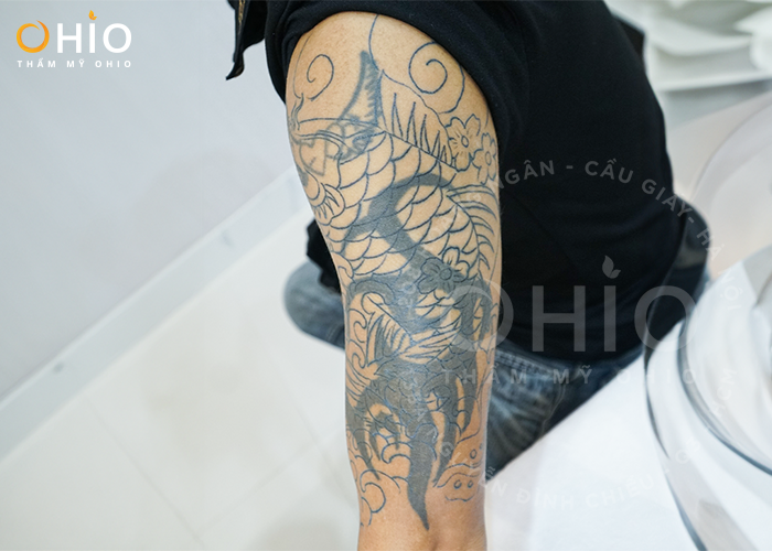 Anh Hưng (Hưng Yên): Xóa hình xăm, công việc của tôi thuận lợi hơn! - Phòng khám da liễu OHIO xoá hình xăm