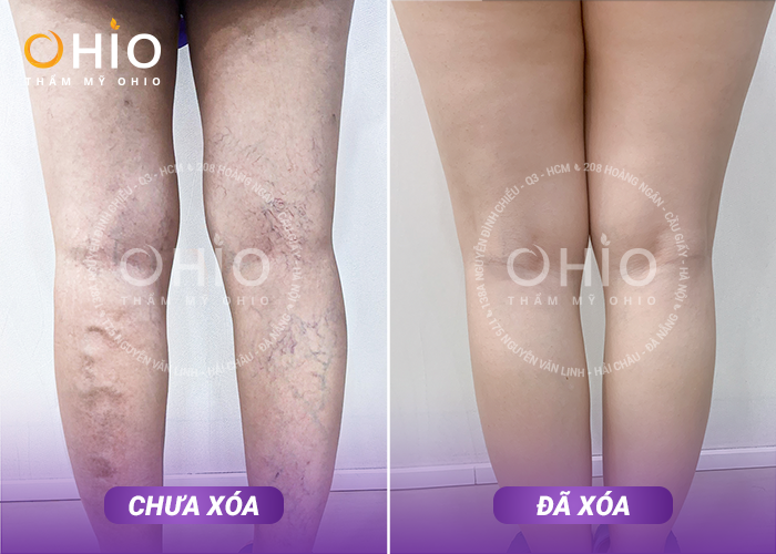 Bí quyết lấy lại đôi chân mất thẩm mỹ vì Giãn mao mạch của cô MC xinh đẹp - Phòng khám da liễu OHIO Bí quyết lấy lại đôi chân mất thẩm mỹ vì Giãn mao mạch của cô MC xinh đẹp