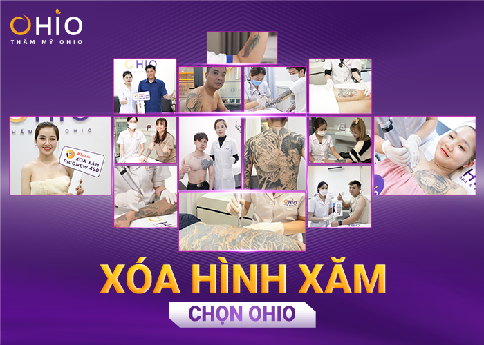 Anh Hưng (Hưng Yên): Xóa hình xăm, công việc của tôi thuận lợi hơn! - Phòng khám da liễu OHIO xoá hình xăm chọn Ohio