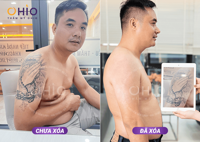 Anh Trung Kiên: Tôi đã xóa sạch hình xăm lâu năm tại OHIO! - Phòng khám da liễu OHIO Anh Trung Kiên: Tôi đã xóa sạch hình xăm lâu năm tại OHIO!